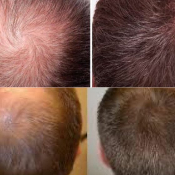 Mesotheraphy for Hair Loss