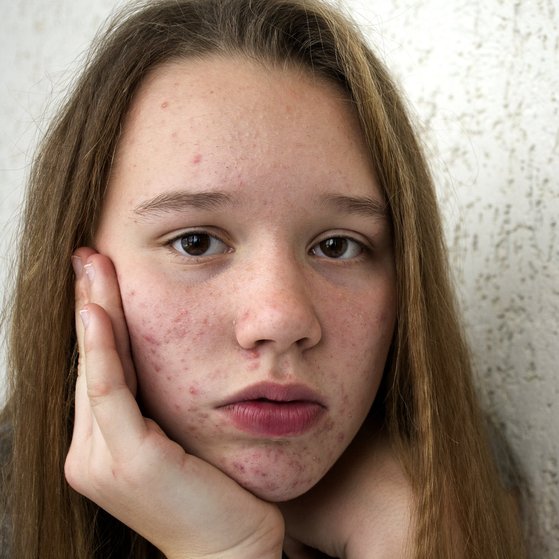What can teenagers do about spots