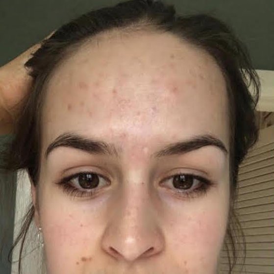 Acne Scarring Before