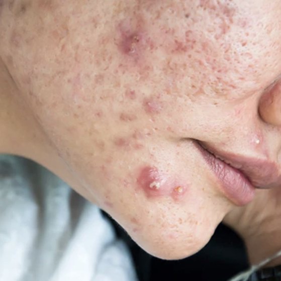Cystic Acne: What is it and what can you do about it?