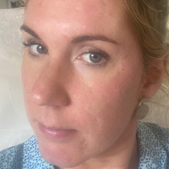 Dermal Fillers Before