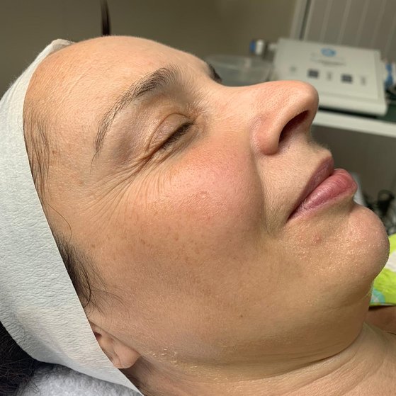 Menopausal Skin Facial Before