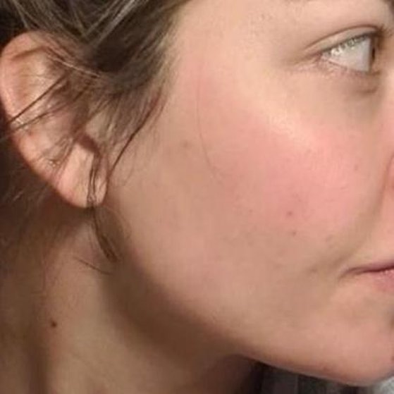 Microneedling After
