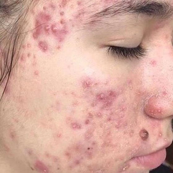 Acne Before