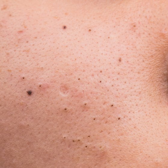 Folliculitis scarring and dark spots - Beauty Insider Community