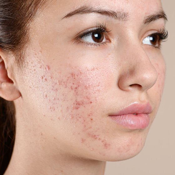 Acne Fact Sheet