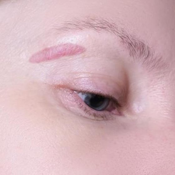 Scars and Keloids Before
