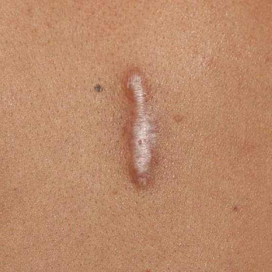 Keloid Scars