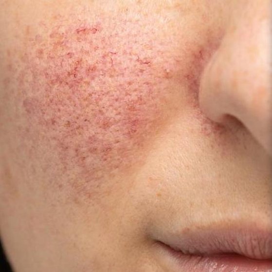 Eczema, Rosacea and Psoriasis Before