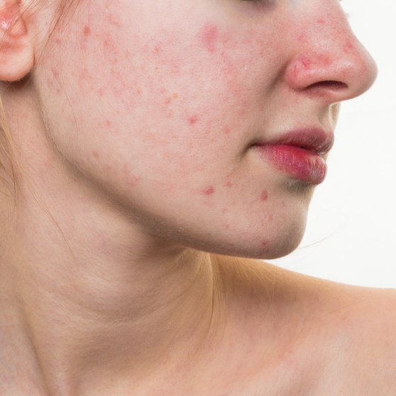 Red Spots and Acne Scars: How to get rid of them.