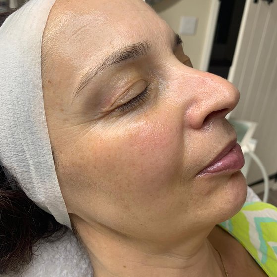 Menopausal Skin Facial After