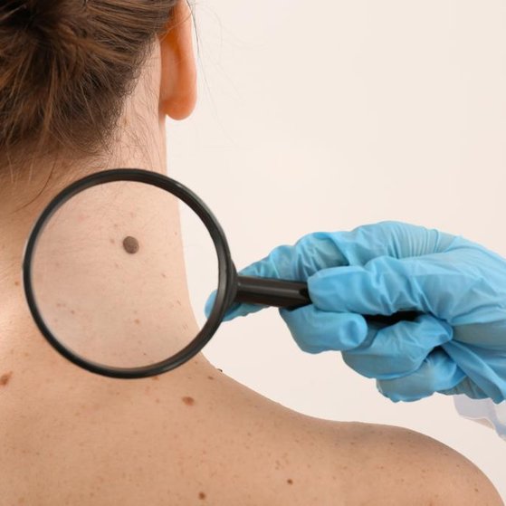 Detection of Skin Cancer