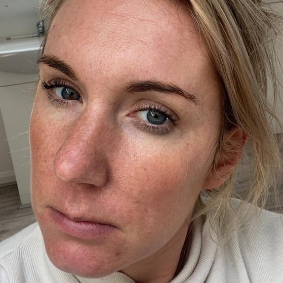Dermal Fillers After