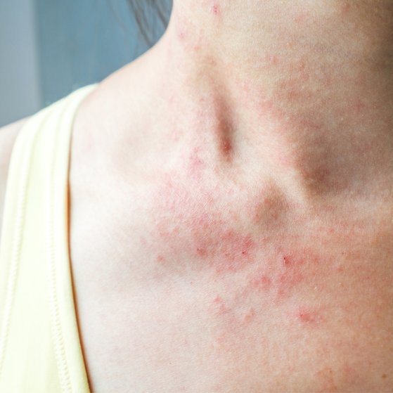 Eczema, Rosacea and Psoriasis