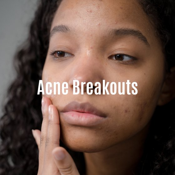 Acne Breakouts