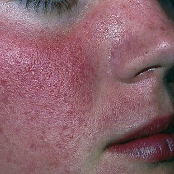 Acne Rosacea