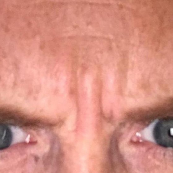 Wrinkle Relaxers Before