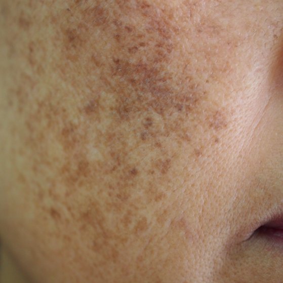 Melasma