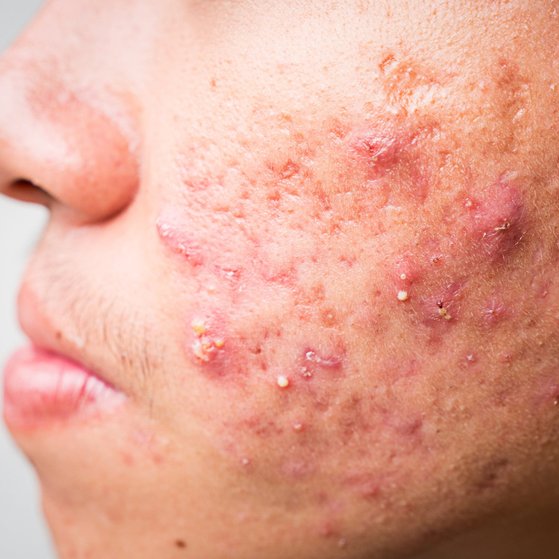 7 things you should know about acne