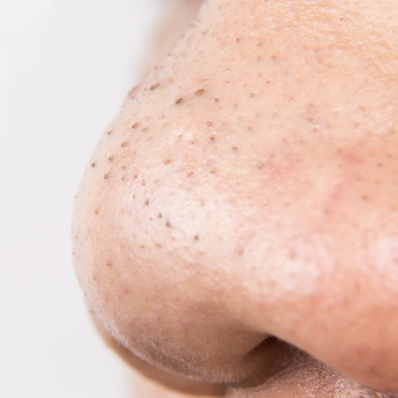 Can you can scrub off blackheads?