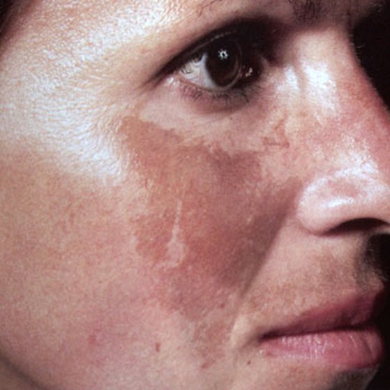 Melasma