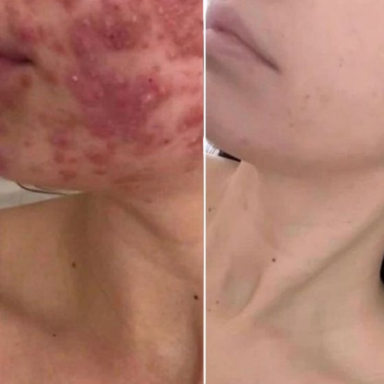 Cystic Acne