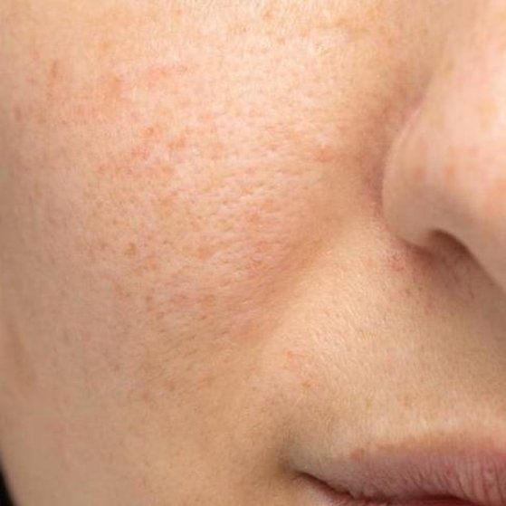 Eczema, Rosacea and Psoriasis After