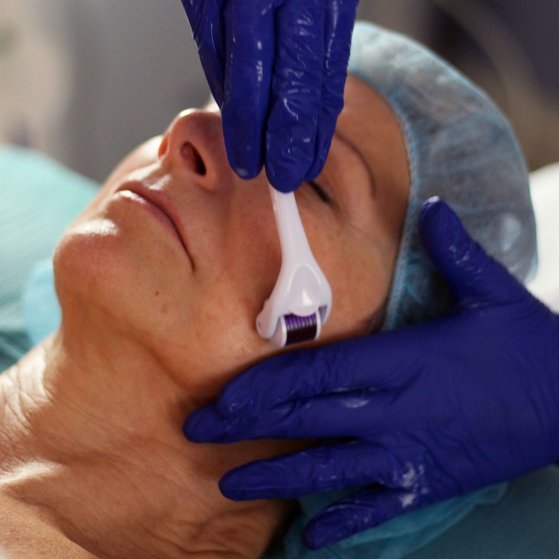 Microneedling