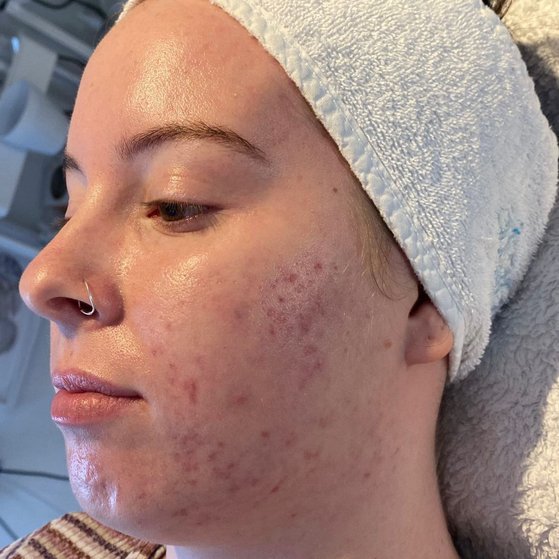 Acne Flare Up Treatment