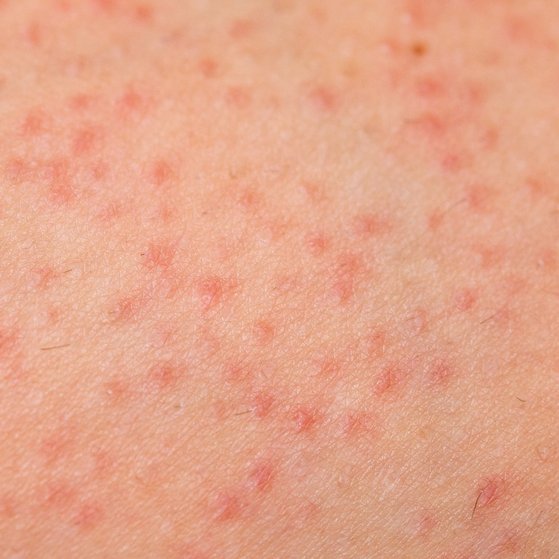 Gram Negative Folliculitis