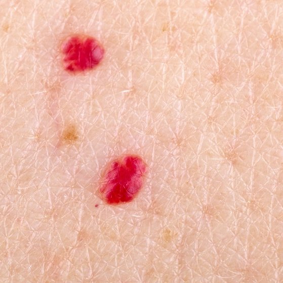 Cherry Angiomas