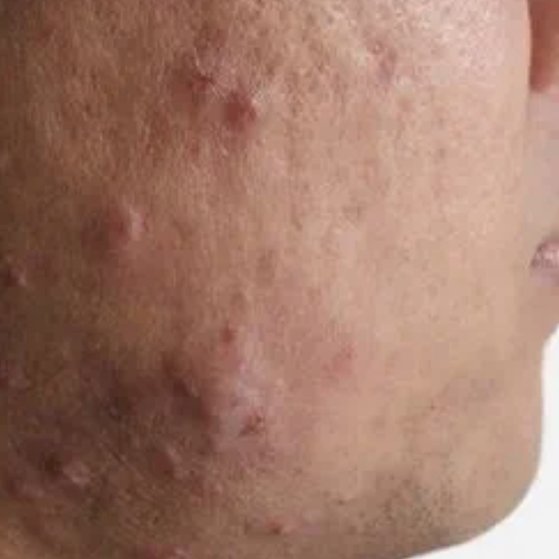 Acne Prone Skin