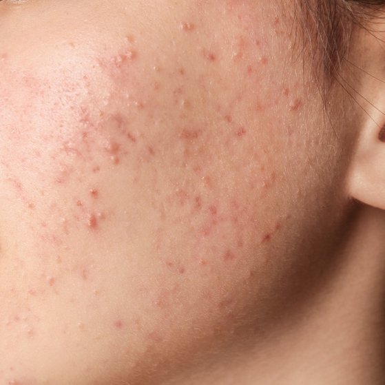 What is acne?