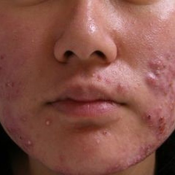 Adult Acne