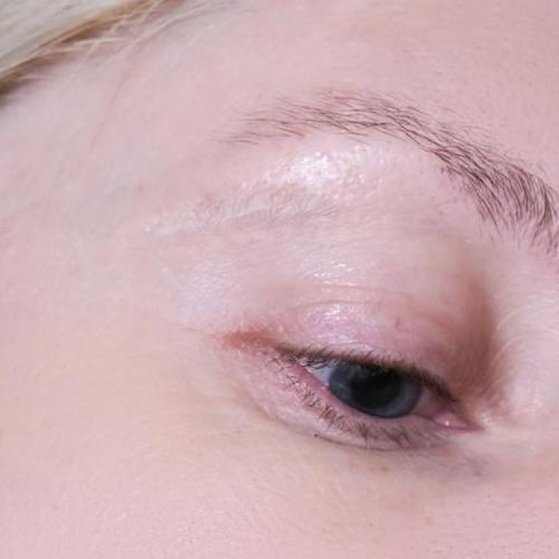 Scars and Keloids After