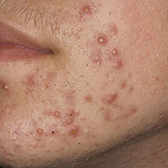 Staphylococci Folliculitis