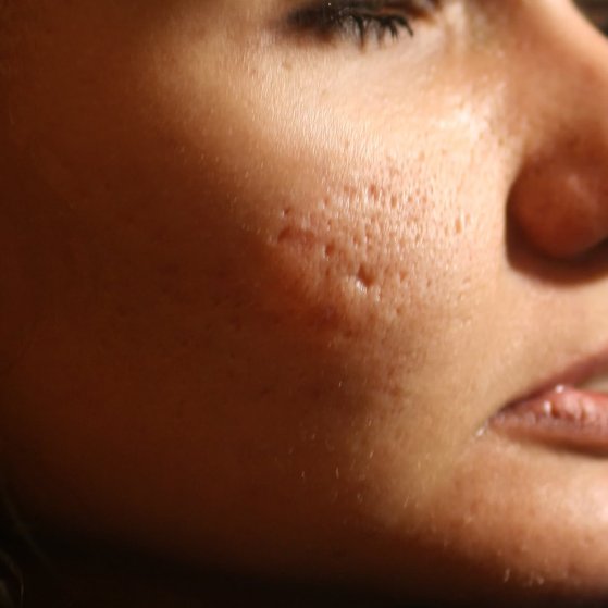 Acne Scarring