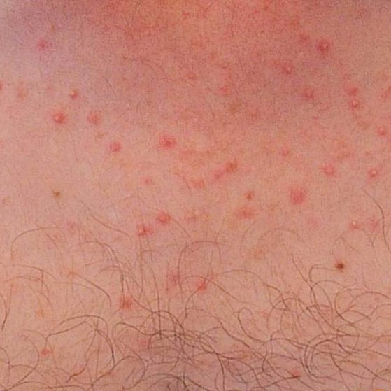 Pityrosporum Folliculitis