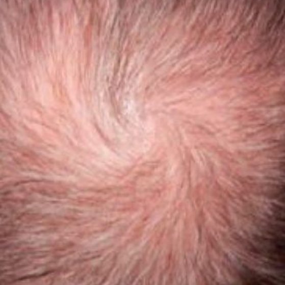 Mesotheraphy for Hair Loss Before