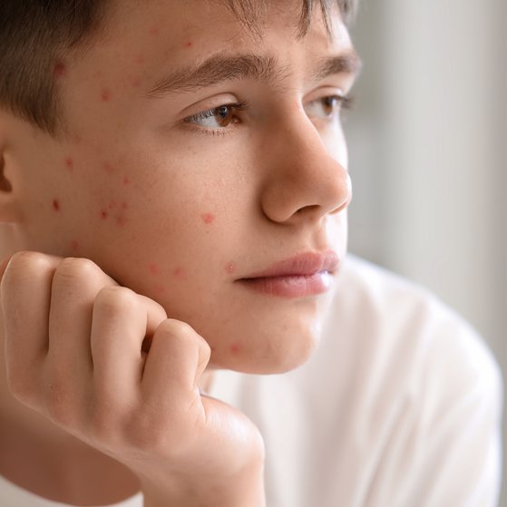 Teenage Acne – what to do