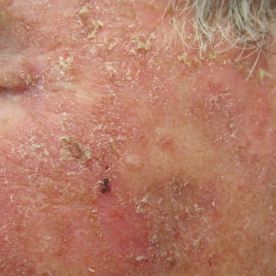 Solar Keratosis