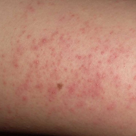 Keratosis Pilaris