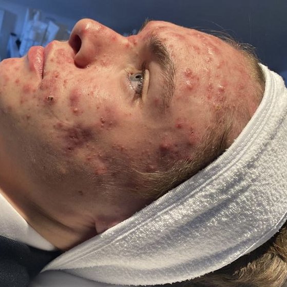 Cystic Acne