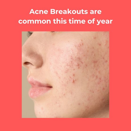 Seasonal Changes & Acne