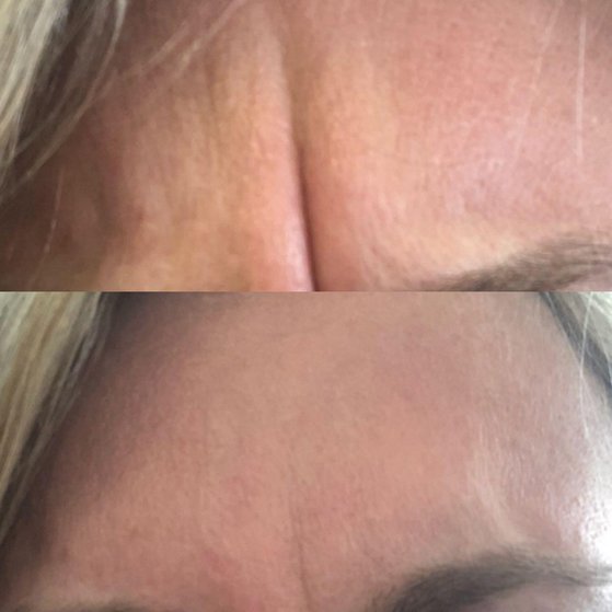 Wrinkle Relaxers